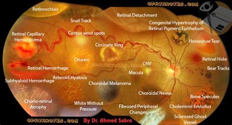 Download Retinal Diseases Signs Picture attachment.php?attachmentid=394 ...