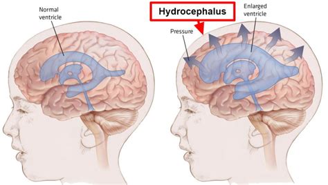 Hydrocephalus - Causes, Symptoms In Babies & Adults, Treatment