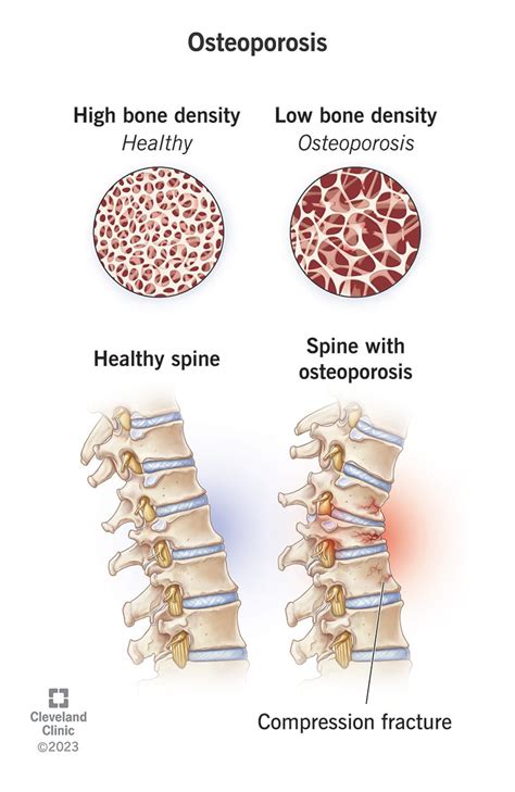 Osteoporosis: Symptoms, Causes and Treatment