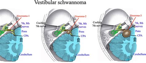 Vestibular schwannoma | دکتر گیو شریفی