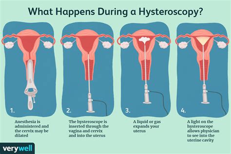 Normal Hysteroscopy