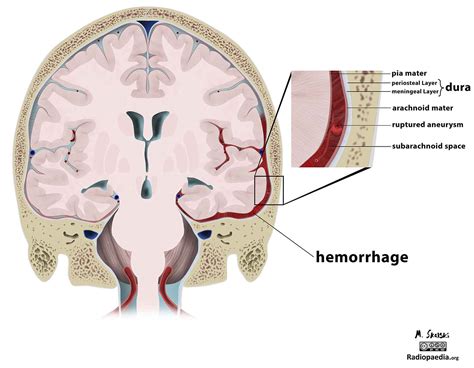 Subdural Hematoma Vs Subarachnoid Hemorrhage