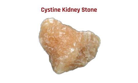 Cystine Kidney Stones- The Nastiest of All | Stone Relief