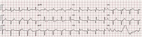 Pe ecg findings - vojordX