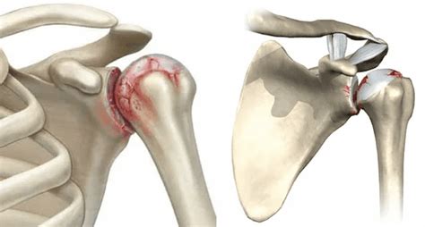 Shoulder arthrosis: symptoms, causes, diagnosis and treatment - Hondrogel