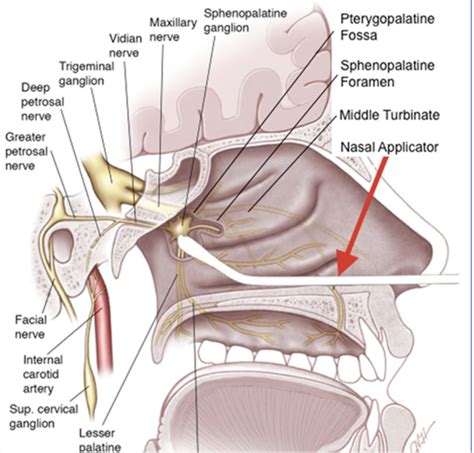 Sphenopalatine (Pterygopalatine) Ganglion Block for Treatment of ...