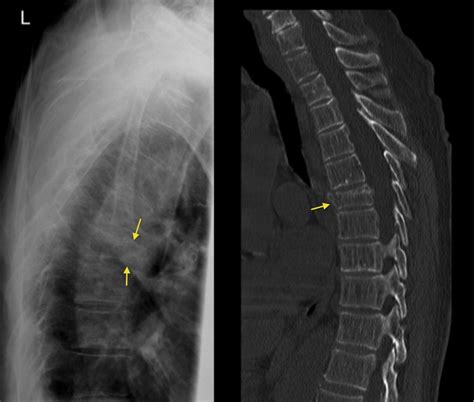 Stress Fracture Spine Recovery Time at Myra Ludlow blog