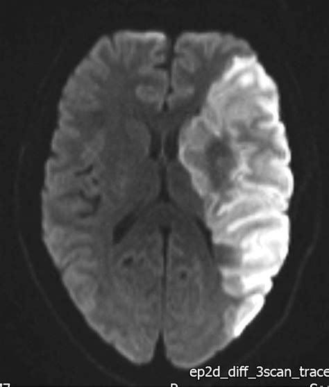 Diffusion-weighted MRI Brain showing restricted diffusion in the region ...