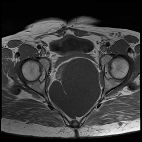 Perirectal Cyst