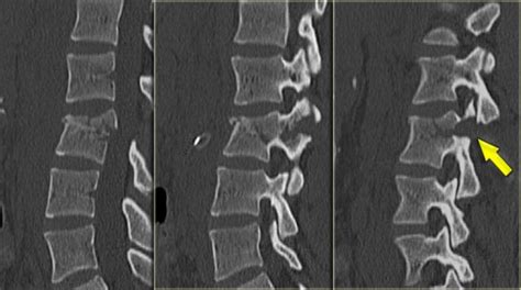 The Radiology Assistant : Thoracolumbar injury