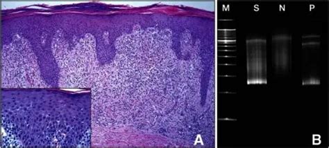 What is Mycosis Fungoides? - Pathosomes