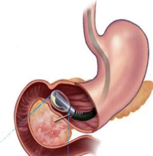 Endoscopic Ultrasound - Cabell Huntington Hospital