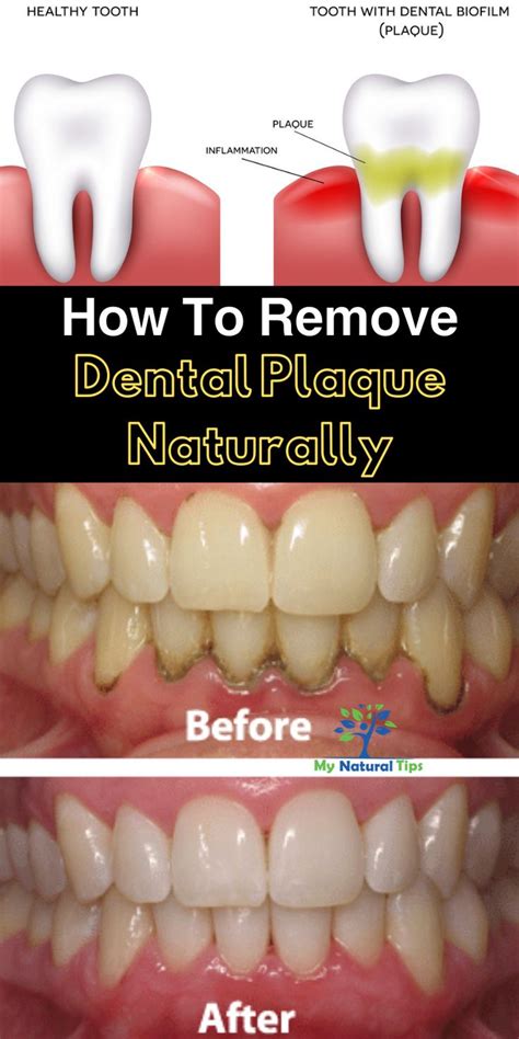 How To Remove Dental Plaque Naturally. | Dental plaque, Plaque removal ...