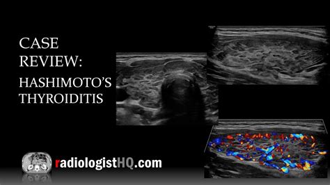 Normal Thyroid Ultrasound