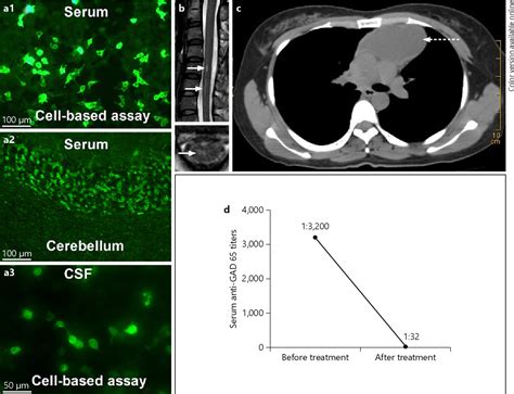 Figure 1 from Glutamic Acid Decarboxylase Antibody in a Patient with ...