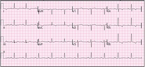 Normal 12 Lead ECG Tracing