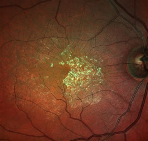 Macular Pucker - Diagnosis - Treatment - Video