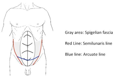 Spigelian hernia | Eurorad