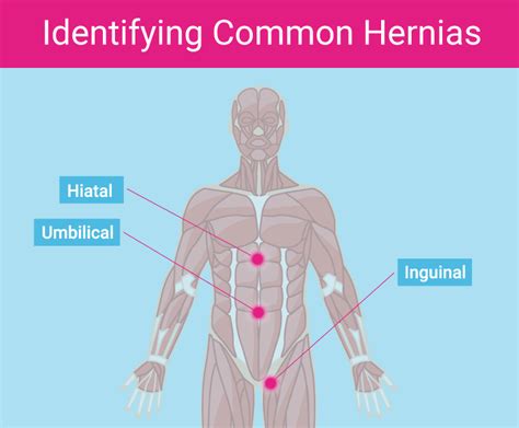 Inguinal Hernia Repair Mesh Vs Non Mesh