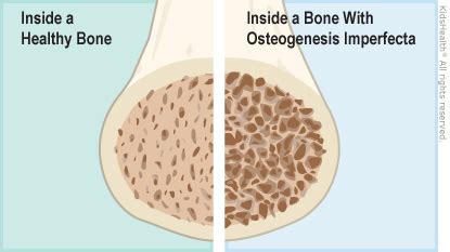 Osteogenesis Imperfecta (Brittle Bone Disease) (for Parents) - Primary ...