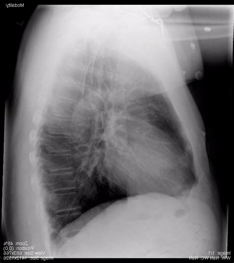 Normal Lateral Chest Xray