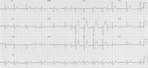 Sinus Arrhythmia • LITFL Medical Blog • ECG Library Basics