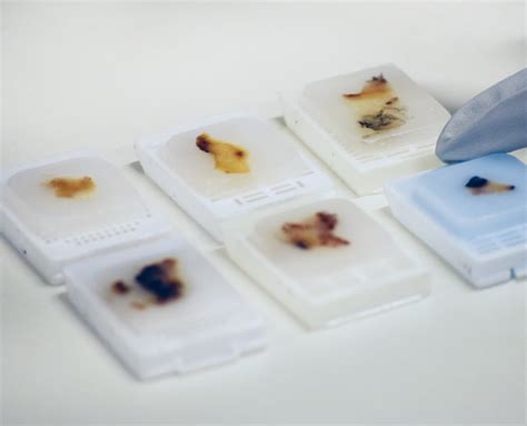 Formalin-Fixed Paraffin-Embedded (FFPE) Tissue | Discovery Life Sciences