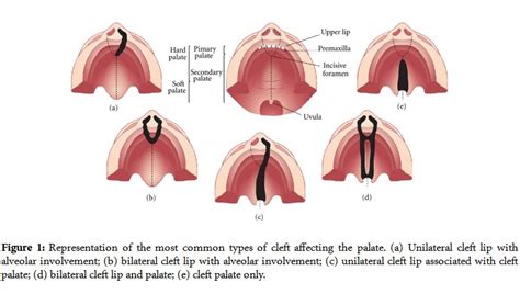 Cleft Palate Anatomy