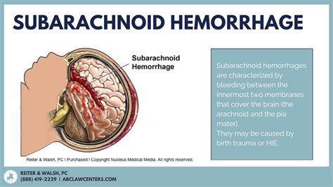 Subarachnoid Hemorrhage in Newborns | ABC Law Centers: Birth Injury Lawyers