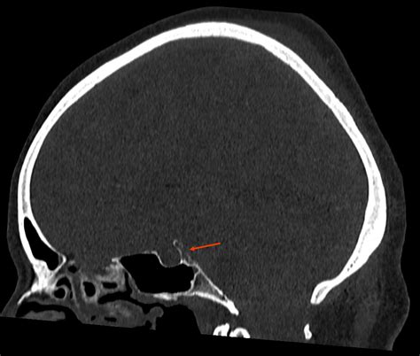 Dorsum sellae - Ars Neurochirurgica