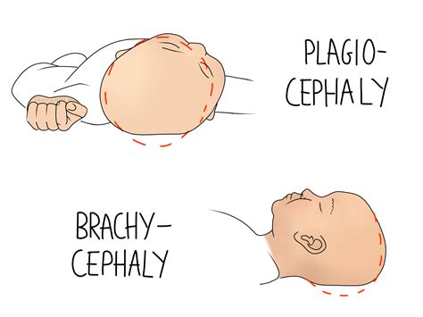 Plagiocephaly - Beth Forrest Osteopathy