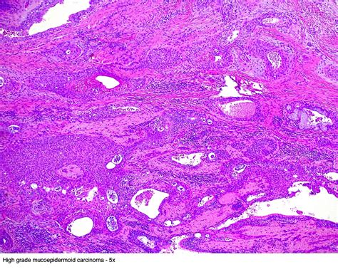 Pathology Outlines - Mucoepidermoid carcinoma