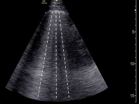 Bedside Echocardiography Diagnosis of Tricuspid Valve Infective ...