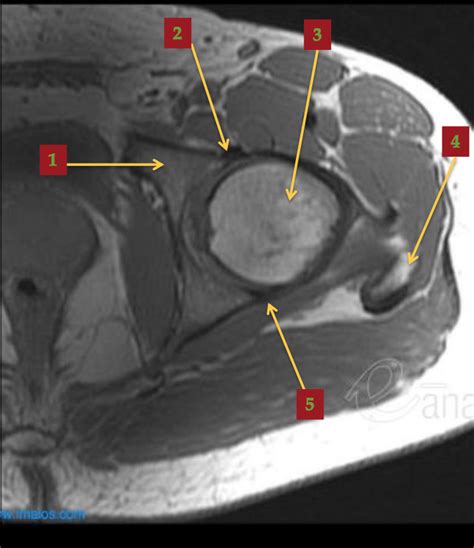 normal hip MRI axial view (class) Diagram | Quizlet