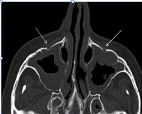 Infraorbital foramina (arrows) are seen in the axial CT image ...