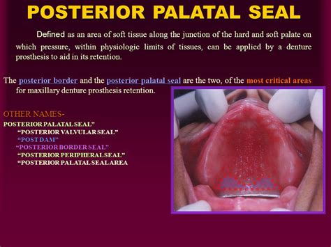 Posterior Palatal Seal Area Anatomy