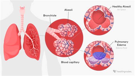 Pulmonary Edema: Symptoms, Causes, Treatments