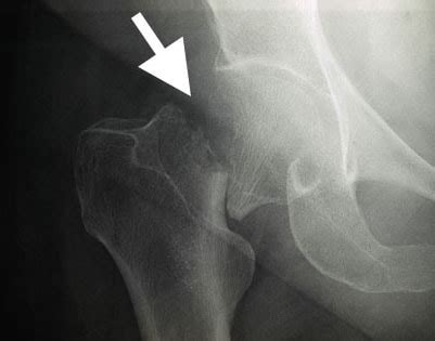 Hip Fractures - OrthoInfo - AAOS