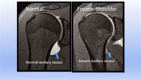 FROZEN SHOULDER: FROZEN SHOULDER