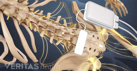 Abbott Spinal Cord Stimulator Manual