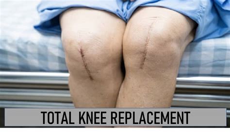 Total Knee Replacement Exercises | Total Knee Replacement Recovery