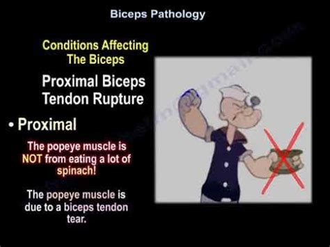 Popeye muscle deformity. Proximal biceps tendon rupture. - YouTube