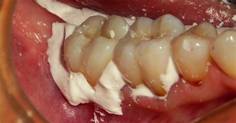 Dental Cement. Temporary Cementation and Permanent Cementation