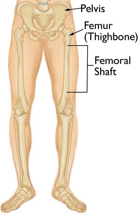 Femur Shaft Fractures (Broken Thighbone) - OrthoInfo - AAOS