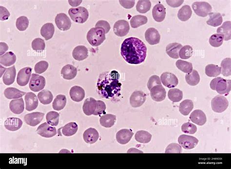 Plasmodium falciparum microscope hi-res stock photography and images ...