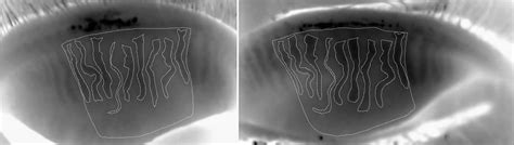 Maskin Meibomian Gland Probing: For Physicians — MGDinnovations