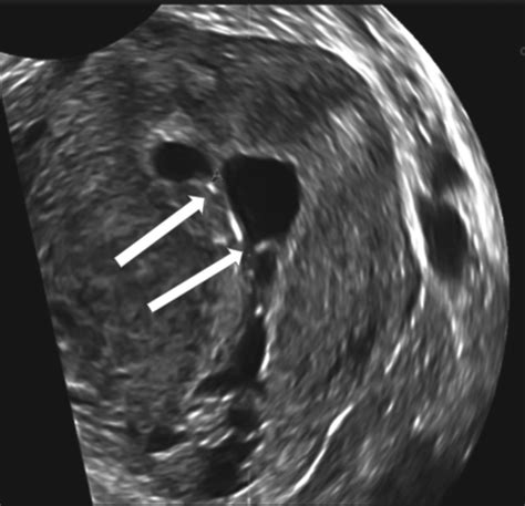 Ultrasound and intrauterine adhesions: a novel structured approach to ...