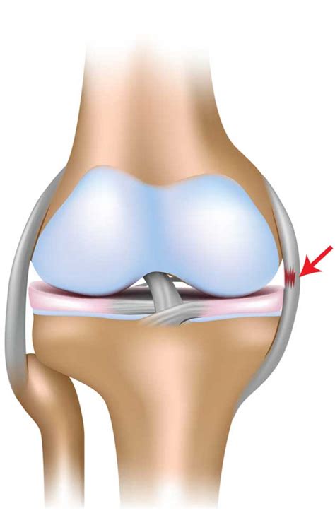 MCL Tear | MCL Injury | MCL Insufficiency | Orthopedic Knee Specialist ...