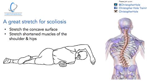 Scoliosis Workout Exercises | EOUA Blog