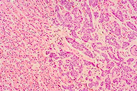 Hepatic Pathology